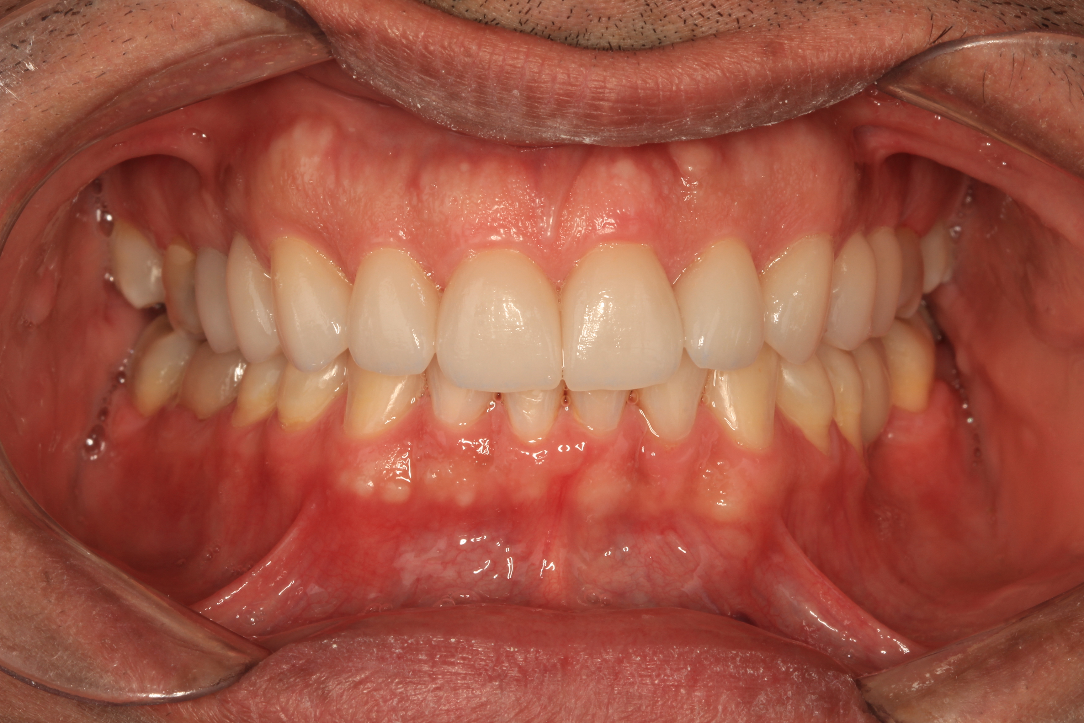 uploads/resultado final facetas multiodonto.jpg